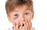 مواصفات طبيعية لعلاج كدمات العين عند الأطفال