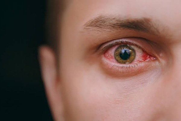 الوقاية من التهابات العين الشائعة أثناء الرياح الموسمية