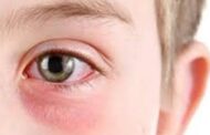 مواصفات طبيعية تساعد علي علاج التهابات العين