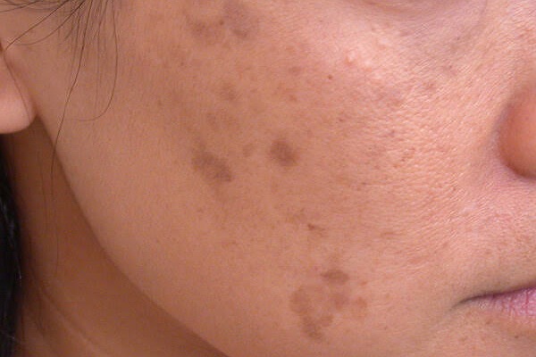 علاجات منزلية تساعد في التخلص من البقع الداكنة على الجلد