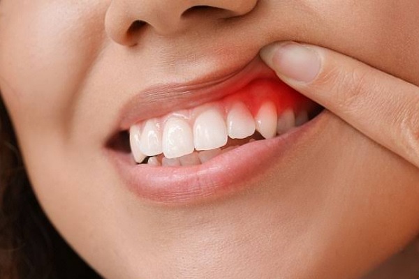 طرق منزلية تساعد في علاج فطريات الفم ....تعرف عليها