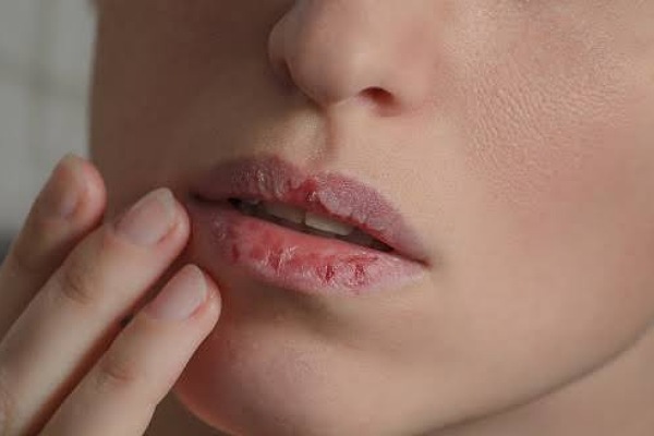 أسباب وأعراض جفاف الفم...تعرف عليها